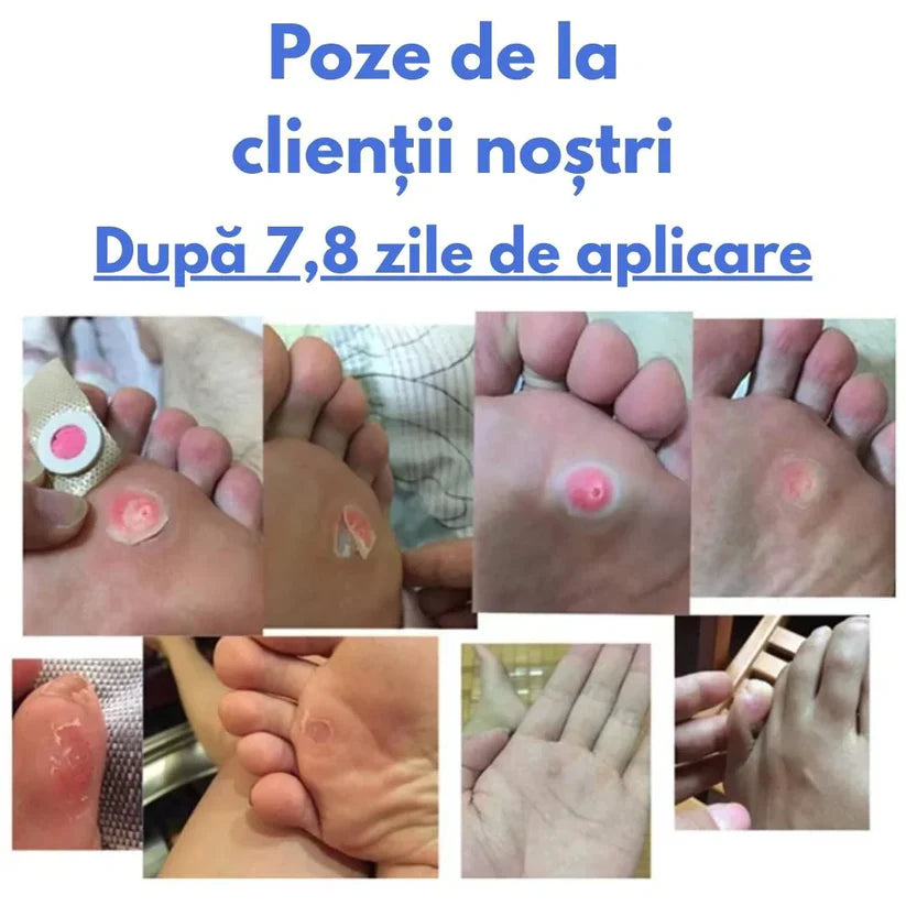Plasturi pentru bǎtaturi şi negi